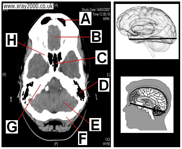 AXIAL SECTION 11.JPG